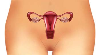 Polycystic Ovary Syndrome (PCOS)